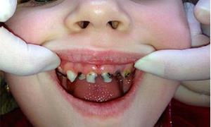 Гнилые зубы у детей