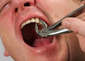 Вырвать зуб